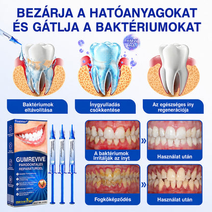🇭🇺🍄🦷1️⃣ Trilumia® GumRevive – fejlett gél az íny és a fogágy ápolására